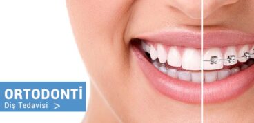 ortodonti diş tedavisi