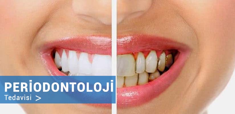 periodontoloji diş tedavisi